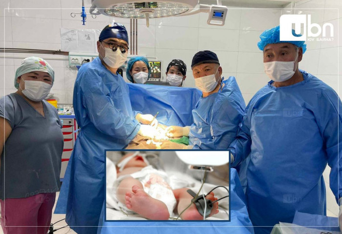 Дархан-Уул аймгийн эмч нар нарийн гэдэсний битүүрэлттэй нярайд мэс засал хийлээ