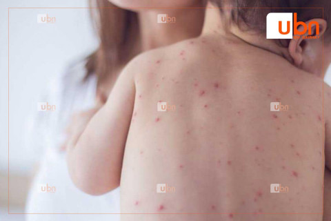 Улаанбурхан өвчний зөөвөрлөгдөн батлагдсан хоёр дахь тохиолдол бүртгэгдлээ
