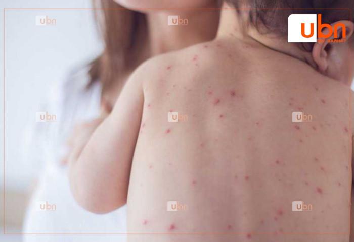 ХӨСҮТ: Улаанбурхан өвчний 8 дахь тохиолдол лабораториор батлагдлаа