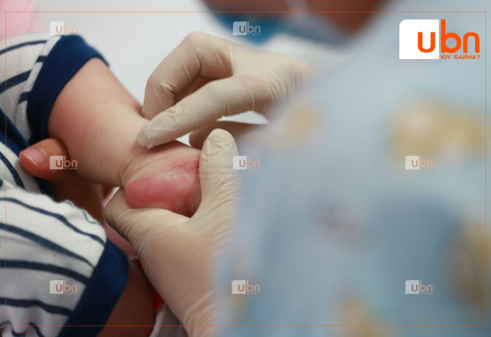 Улаанбурхан өвчний батлагдсан тохиолдол 13677 болжээ