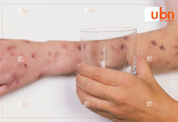 СЭРЭМЖЛҮҮЛЭГ: Увс аймагт менингитийн халдвараар 5 настай хүүхэд өвчилжээ