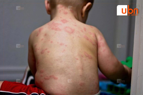 ХӨСҮТ: Бэлтгэсэн уусмалаар хоолойгоо зайлах нь Менингококкт халдвараас сэргийлнэ