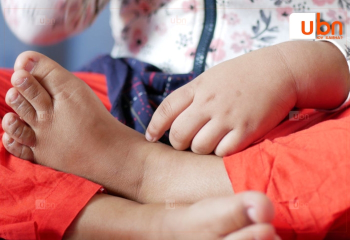 Ховд аймагт 6 настай хүүхэд цахилгаан менингитээр нас баржээ