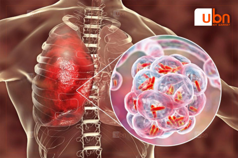 Сүрьеэ өвчинтэй тэмцэх Дэлхийн өдөр тохиож байна