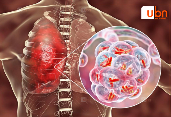 Сүрьеэ өвчинтэй тэмцэх Дэлхийн өдөр тохиож байна